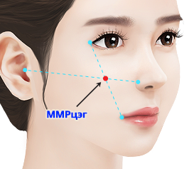High L зүсэлтээр шанаа багасгах мэс засал Нүдний төгсгөл болон уруулын