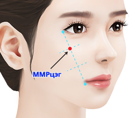 High L зүсэлтээр шанаа багасгах мэс засал нүдний доорх хэсэгт