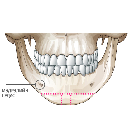Mini V line Урд эрүүний мэс засал Өргөн урд эрүү