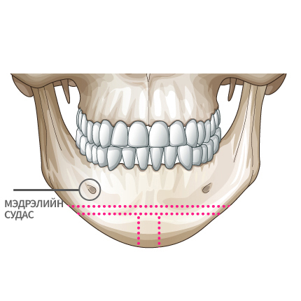 Mini V line Урд эрүүний мэс засал Урагш түрсэн урд эрүү