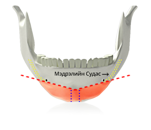 V line дөрвөлжин эрүүний мэс засал Y зүсэлт