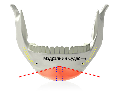 V line дөрвөлжин эрүүний мэс засал ㅅ зүсэлт