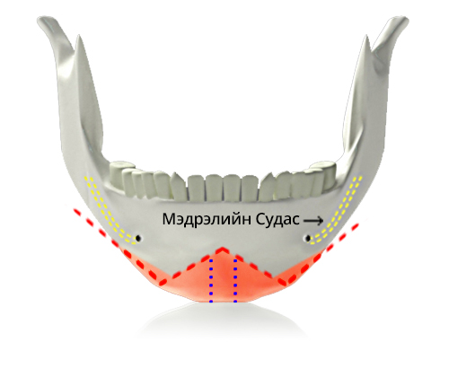 V line дөрвөлжин эрүүний мэс засал W зүсэлт