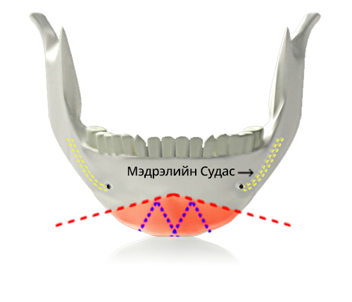 V line дөрвөлжин эрүүний мэс засал M зүсэлт