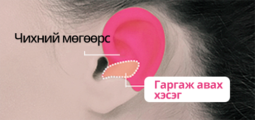 Хиймэл мөгөөрс ашиглаж хамрын үзүүр засах мэс засал Чихний мөгөөрс