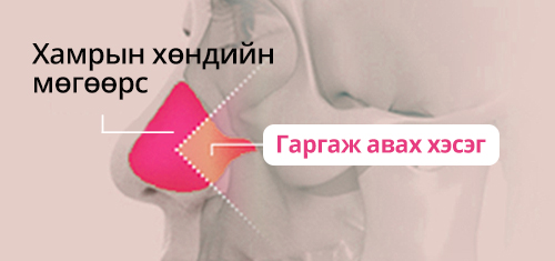 Хиймэл мөгөөрс ашиглаж хамрын үзүүр засах мэс засал Хамрын хөндийн мөгөөрс