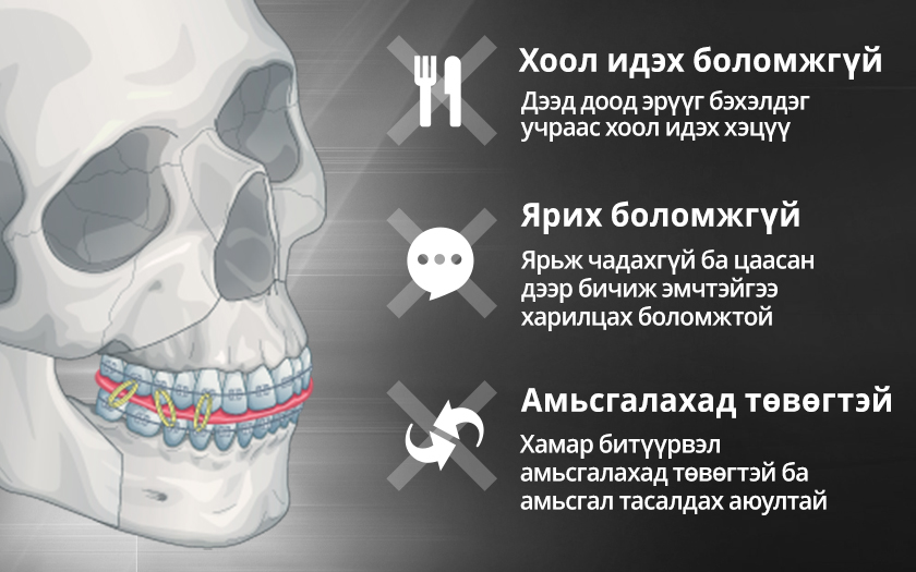 Бэхэлгээгүй эрүүний гажиг засах мэс засал Үндсэн гажиг засах мэс засал