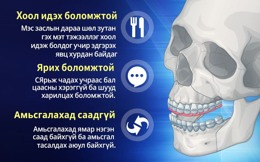 Бэхэлгээгүй эрүүний гажиг засах мэс засал мэс заслын дараа бэхэлгээ