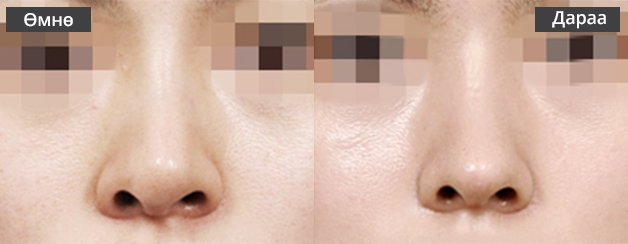 Хамрын давтан мэс засал хиймэл биет хазайсан тохиолдолд