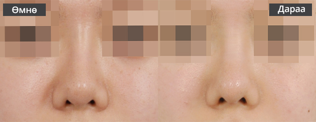 Хамрын давтан мэс засал Хамрын нуруу хэт өндөр тохиолдолд