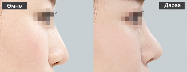 Хамрын давтан мэс засал Хамрын үзүүр навтайсан тохиолдолд