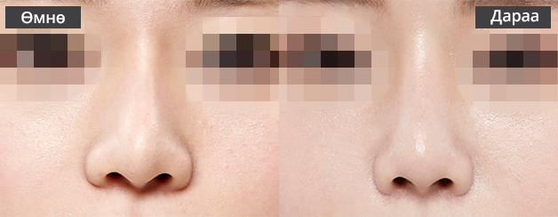 Хамрын давтан мэс засал Хамрын нуруу хэт нарийнхан тохиолдолд