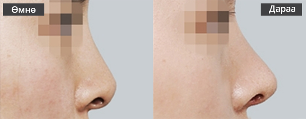 Хамрын давтан мэс засал Хамрын хэлбэр өөрчлөгдсөн тохиолдолд