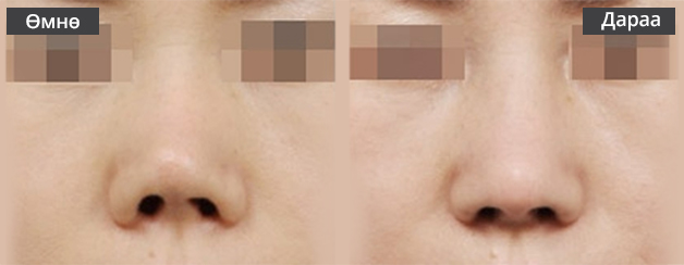 Хамрын давтан мэс засал Хамар богиноссон тохиолдолд